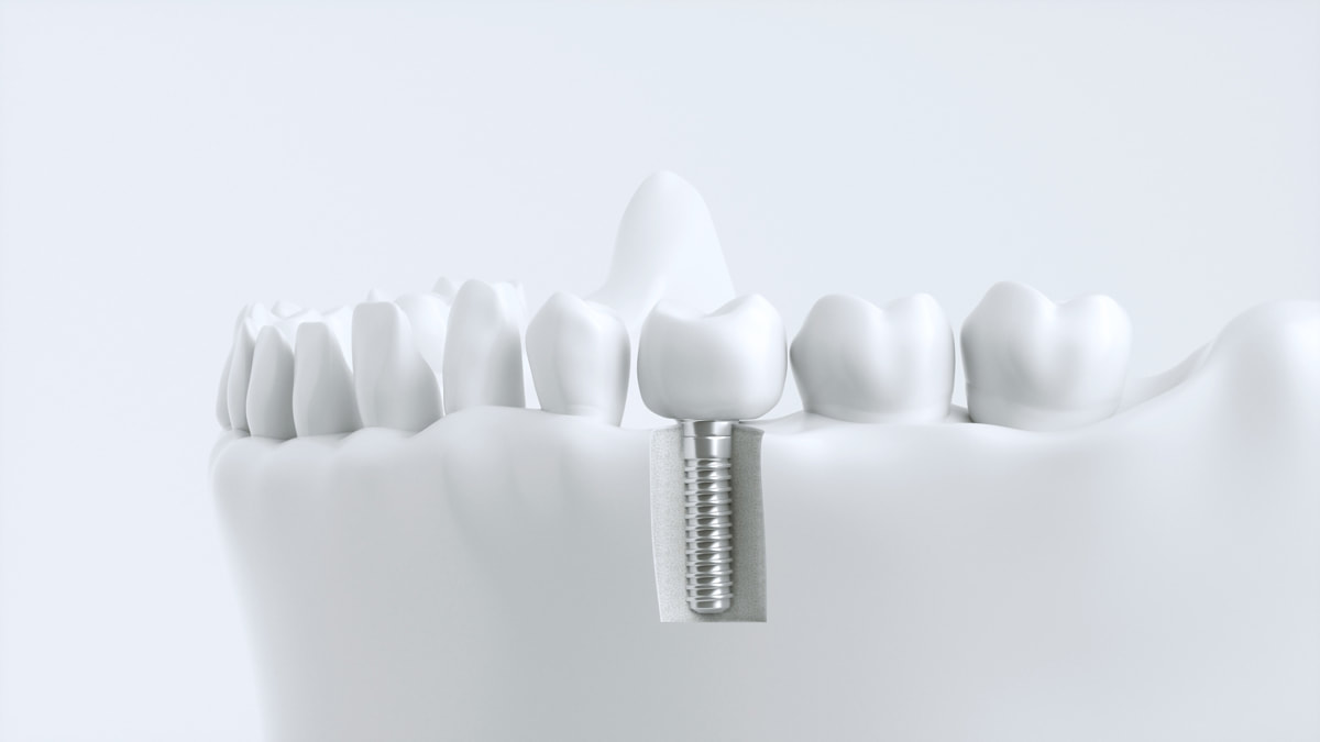 Креативная реклама имплантации зубов