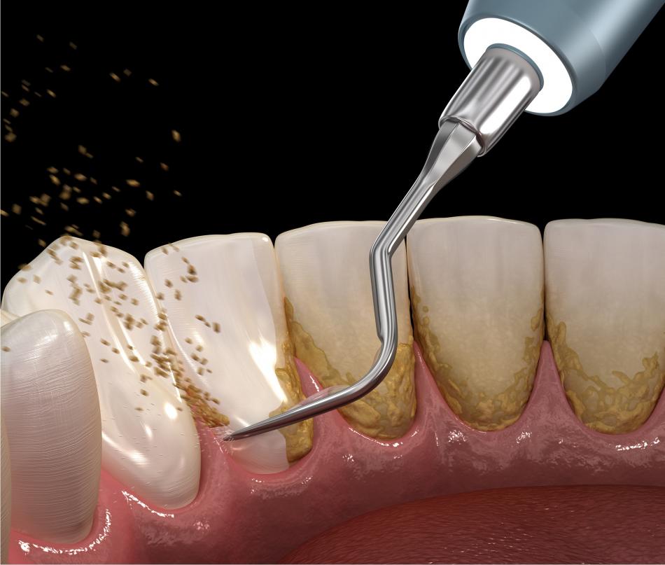 Что такое зубной налет?